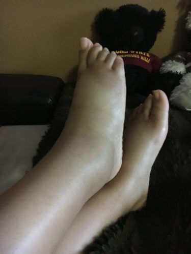 Edema