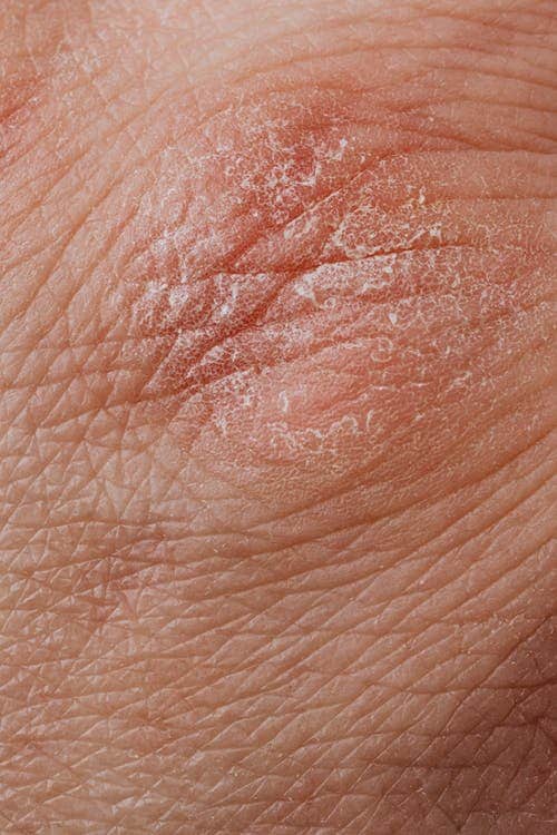Beginning of Seborrheic Dermatitis