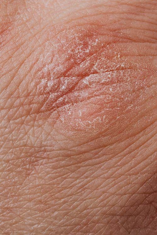 Seborrheic Dermatitis Causes And Treatment Hungry Fit Foodie