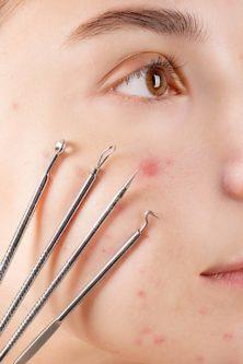 Woman's Face With Four Skin Extractor Tools. Cystic Acne.