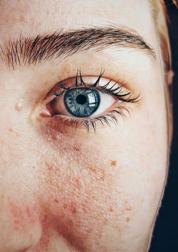 White woman with blue eyes with a facial rash around nose