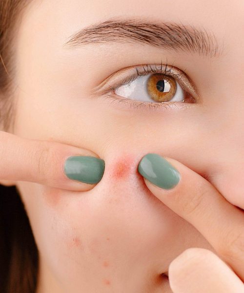 White woman popping a pimple on her face. Acne.