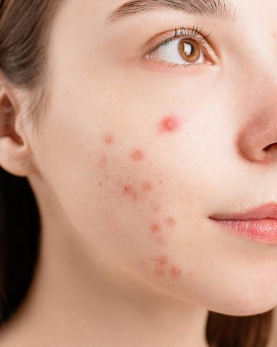 Young white woman with red acne pimples on her cheeks. Foods that cause acne